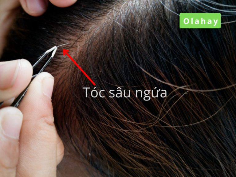 Read more about the article Tóc sâu ngứa là gì? Nguyên nhân và cách khắc phục tóc xoăn ngứa