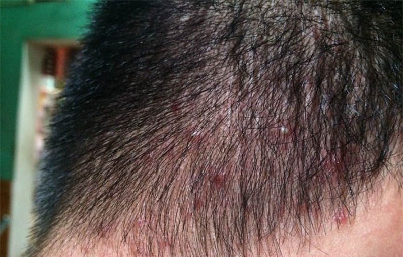 Tóc sâu ngứa vì bệnh da liễu ở đầu
